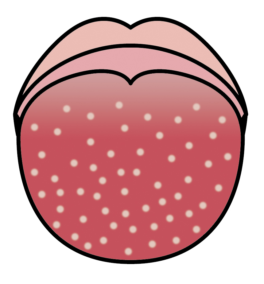 溶連菌感染症によるイチゴ舌