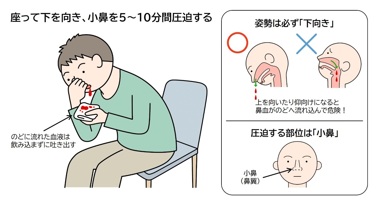 鼻血の止め方は、座って下を向き小鼻を5～10分圧迫する