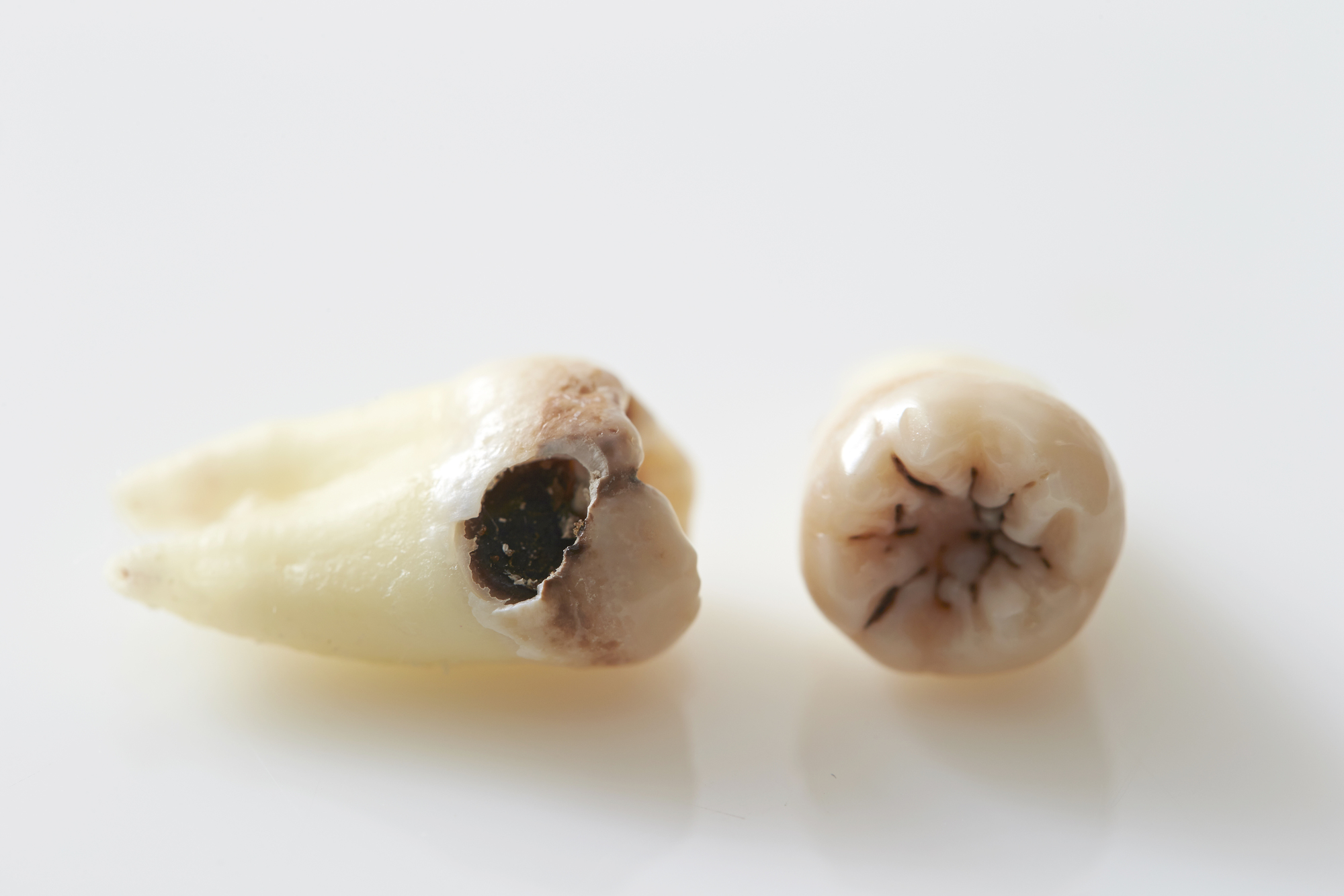 虫歯