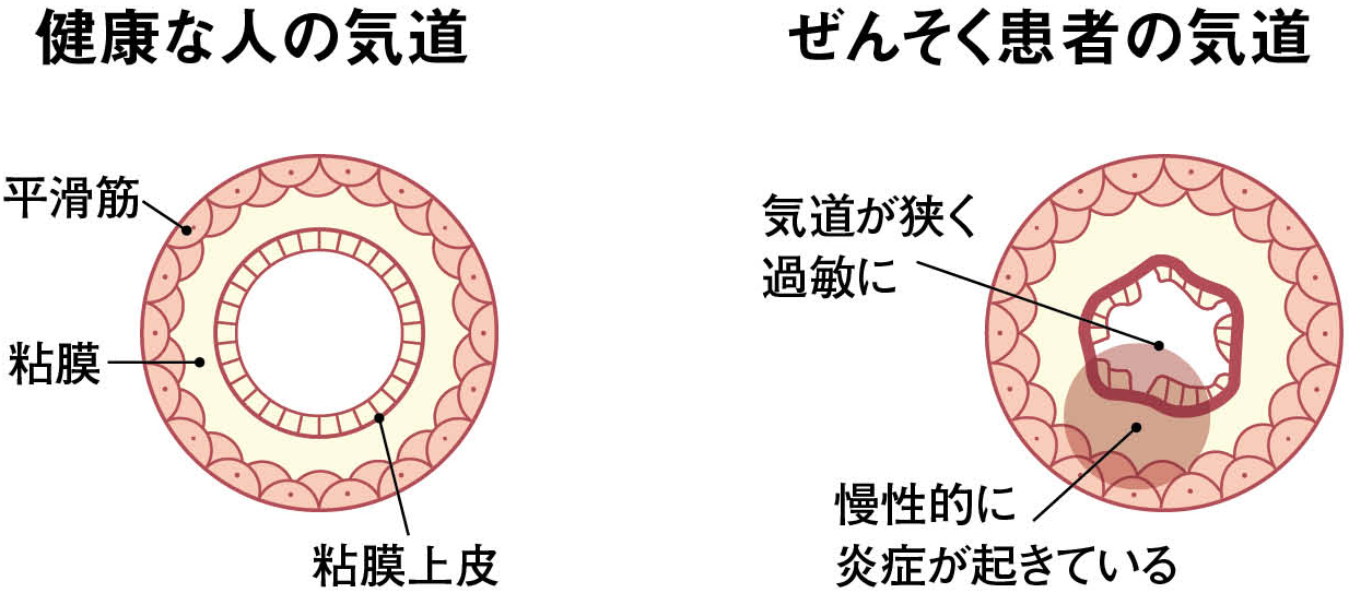 喘息の人の気道