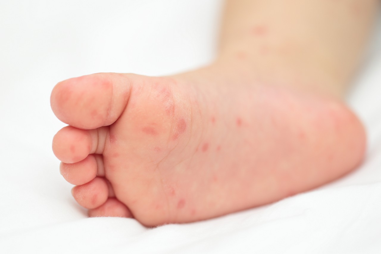 手足口病のリスクがあるのは誰ですか?