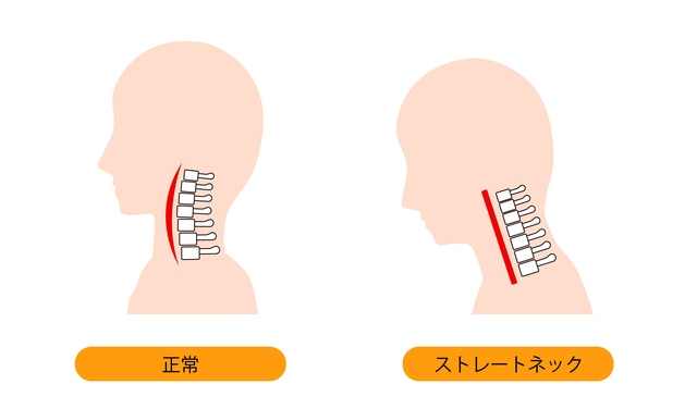 正常な頸椎とストレートネックになってしまった頸椎