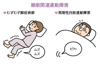 過眠症（ナルコレプシー、突発性過眠症・周期性過眠症）と睡眠関連運動障害（むずむず脚症候群、周期性四肢運動障害）