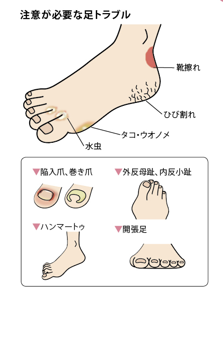 糖尿病で注意が必要な足トラブル