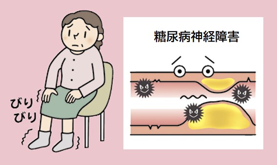 糖尿病神経障害