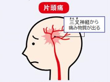 片頭痛は三叉神経から痛み物質が出る