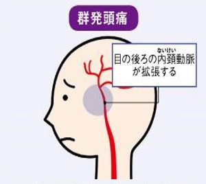 群発頭痛は目の後ろの内頚動脈が拡張する