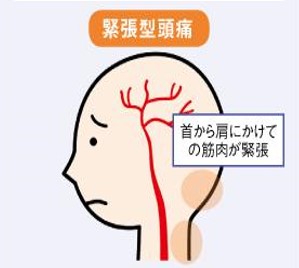 緊張型頭痛は首から肩にかけての筋肉が緊張