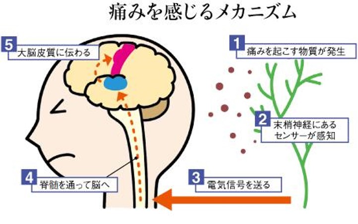 痛みを感じるメカニズム