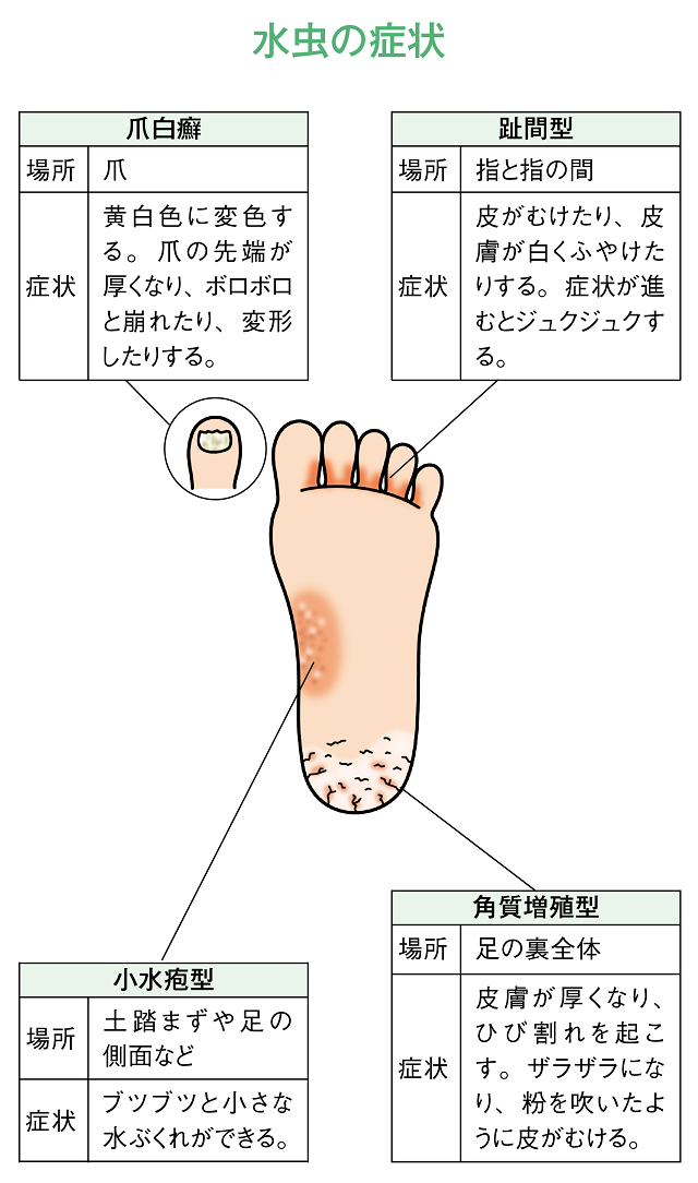 水虫の症状