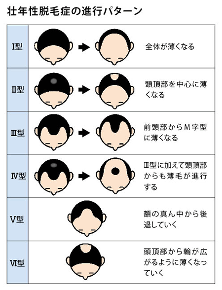 壮年性脱毛症の進行パターン