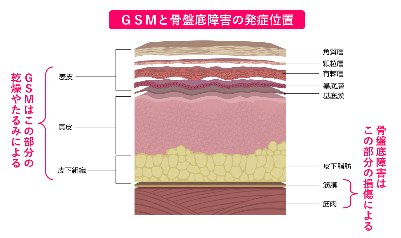 GSMと骨盤底障害の発症位置