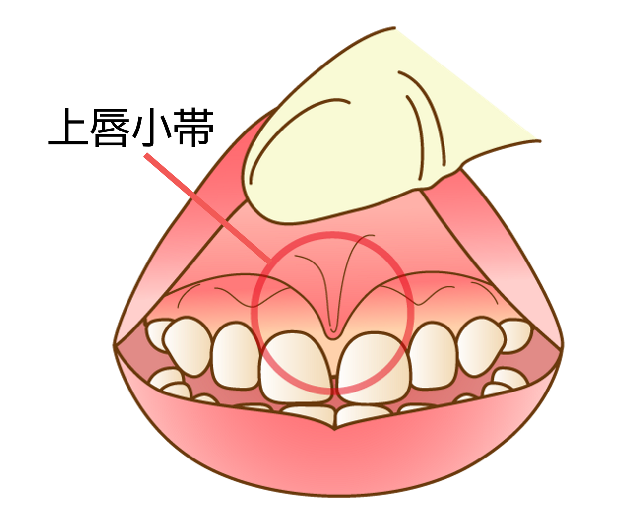 痛みを感じさせないために重要なのは、前歯の中央にある筋「上唇小帯」に歯ブラシがぶつからないようにすること