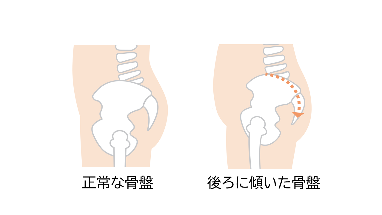正常な骨盤位置と、後ろに傾いた骨盤の位置のイラスト
