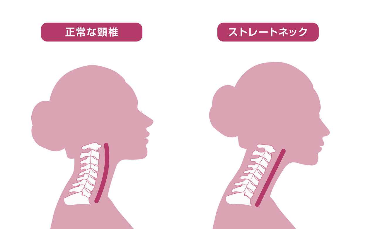 正常な頸椎とストレートネックの違いのイラスト
