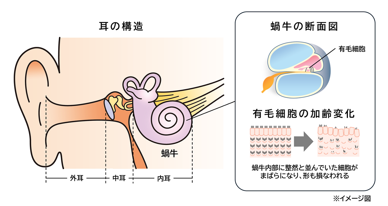 耳の構造のイメージ図。「加齢性難聴」の原因は、内耳の蝸牛にある「有毛細胞」の加齢による減少と言われる。蝸牛内部に整然と並んでいた有毛細胞が、加齢でまばらになり形も損なわれる。