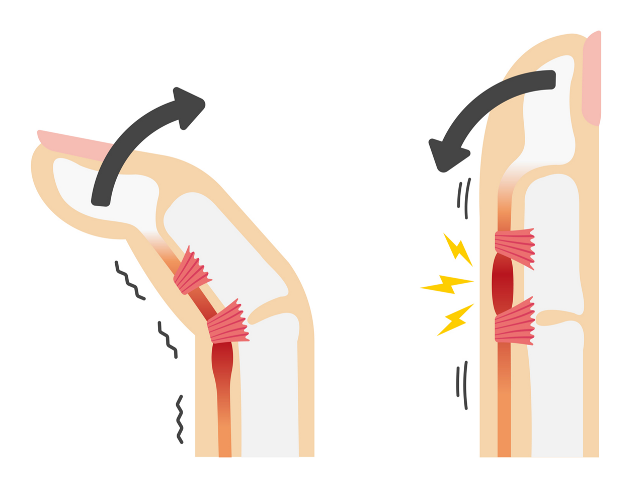 腱鞘炎（けんしょうえん）によって起こる「ばね指」のイラスト