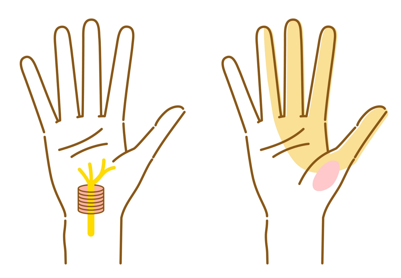 手の小指以外の指に症状が出やすい「手根管症候群」のイラスト