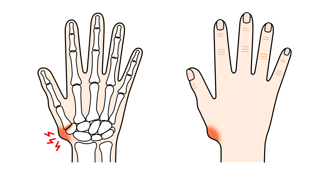 手の親指のつけ根に症状が出やすい「母指CM関節症」のイラスト
