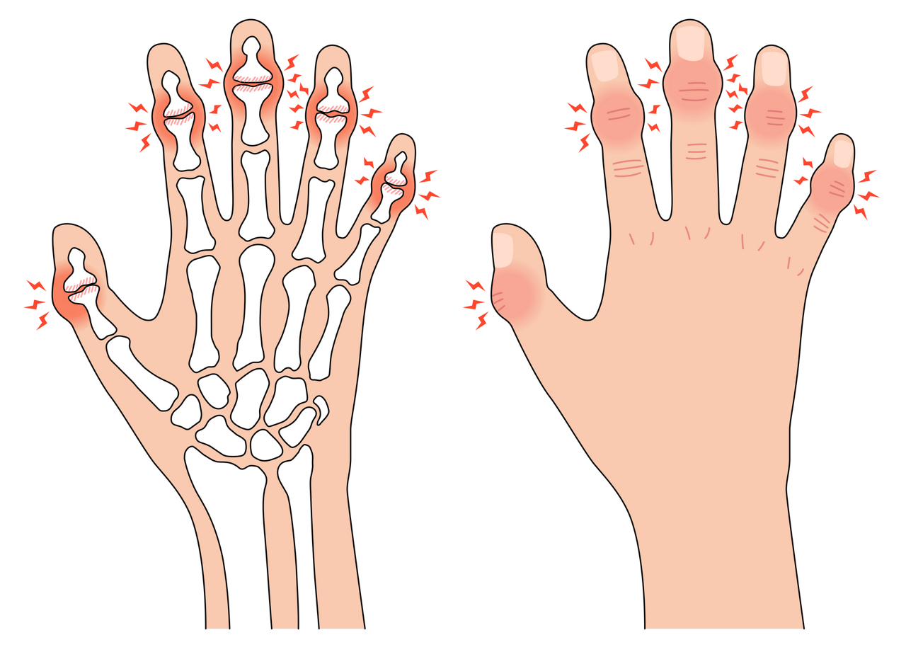 手の第一関節に症状が出やすいヘバーデン結節のイラスト