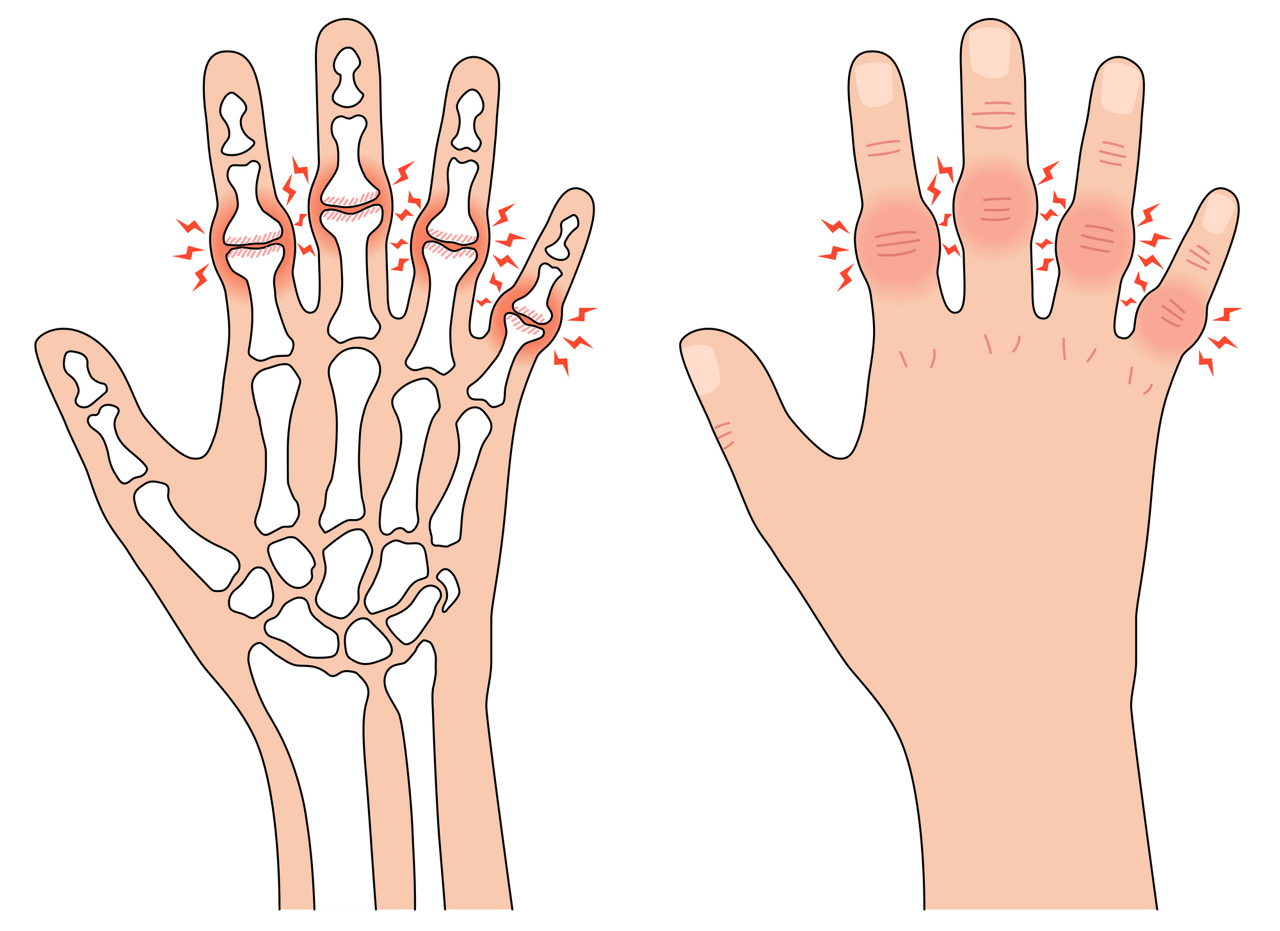 手の第二関節に症状が出やすい「ブシャール結節」のイラスト