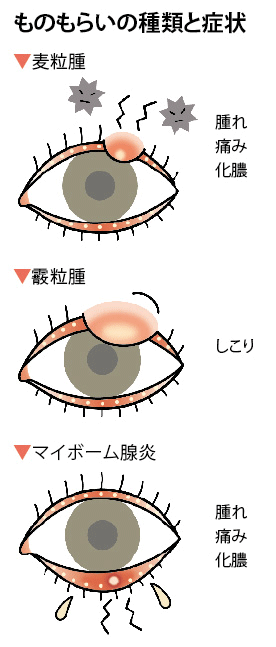 ものもらいの種類と症状