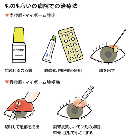 ものもらいの病院での治療法