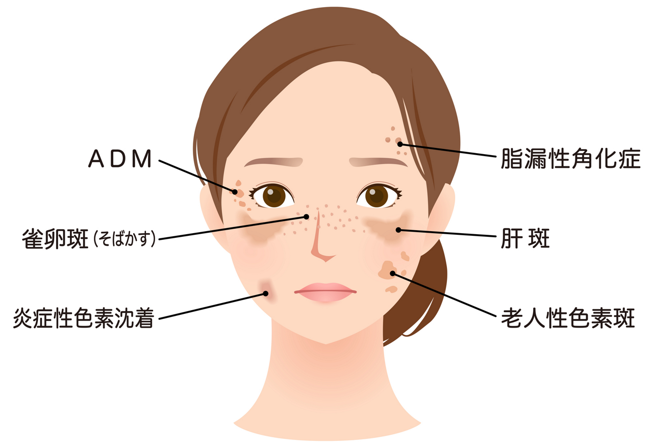 代表的な6種類のシミ「老人性色素斑」「炎症後色素沈着」「雀卵斑（そばかす）」「肝斑」「脂漏性（しろうせい）角化症」「ADM（後天性真皮メラノサイトーシス）」のイメージ画像