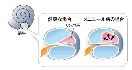 蝸牛の断面図と発症の仕組み