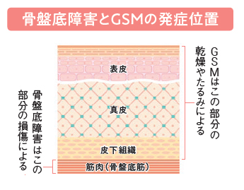 骨盤底障害とGSMの発症位置