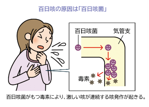 百日咳の原因は百日咳菌。百日咳菌が持つ毒素により、激しい咳が連続する咳発作が起きる。