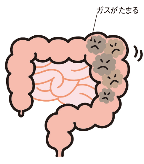 悪玉菌の異常発酵