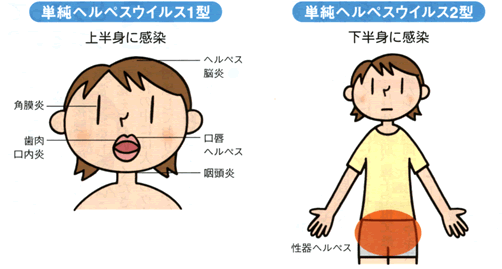 口唇ヘルペス 正しい知識で早めにケア 口唇ヘルペス 正しい知識で早めにケア
