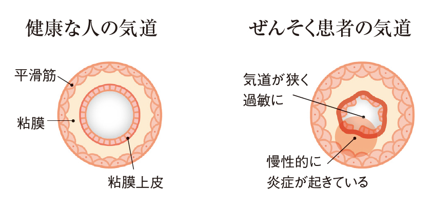 健康な人の気道とぜんそく患者の気道