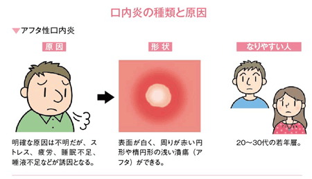 口内炎の種類と原因（アフタ性口内炎）