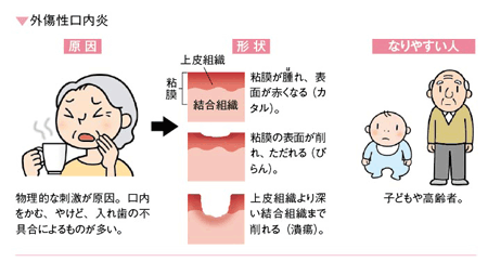 口内炎の種類と原因（外傷性口内炎）