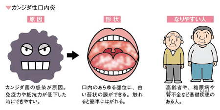 口内炎の種類と原因（カンジダ性口内炎）