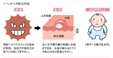 口内炎の種類と原因（ヘルペス性口内炎）