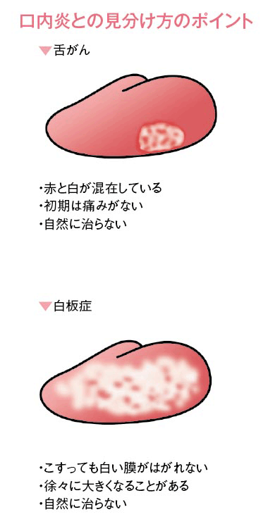 口内炎との見分け方ポイント