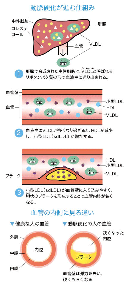 動脈硬化が進む仕組み