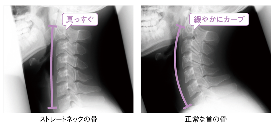 ストレートネック（スマホ首）