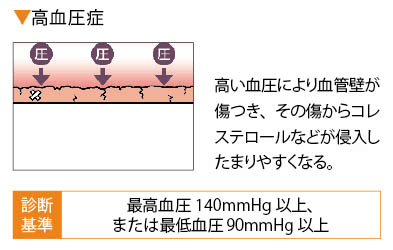 高血圧症