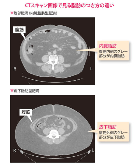 CTスキャン画像で見る脂肪のつき方の違い