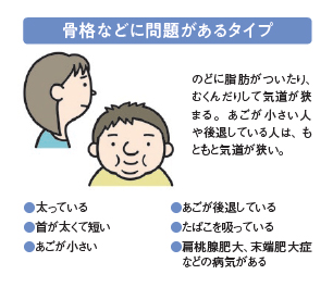 気道を狭める３つのタイプ：骨格などに問題があるタイプ