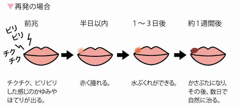 口唇ヘルペス再発の時の症状（チクチク・ピリピリしたり、かゆみやほてりの前兆から、赤く腫れ、水ぶくれができる。1週間後程度で、かさぶたになり、その後数日で自然に治る。）