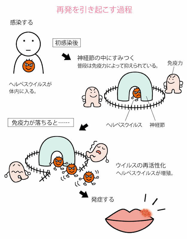 口唇ヘルペス再発を引き起こす過程