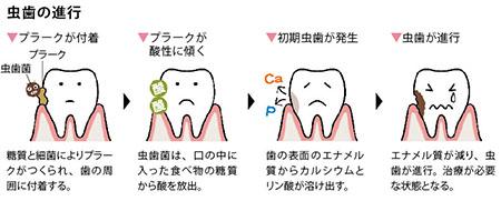 歯にプラークが付着→プラークが酸性に傾く→初期虫歯が発生→虫歯が進行