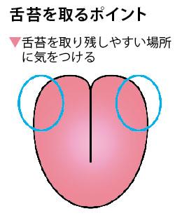 口臭の原因、舌の汚れ（舌苔）を取るポイント