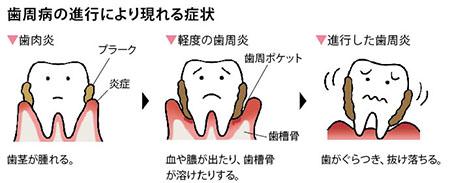 歯周病の進行により現れる症状