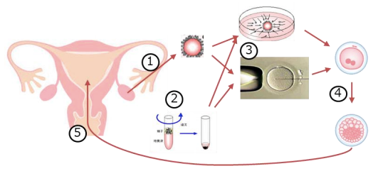 生殖補助医療の保険診療の範囲は、①採卵、②採精、③体外受精/顕微授精、④胚培養、⑤胚移植